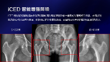 数字化X线摄影未来趋势之超低剂量化