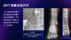 数字化X线摄影未来趋势之超低剂量化