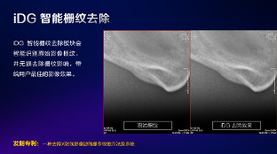 数字化X线摄影未来趋势之超低剂量化